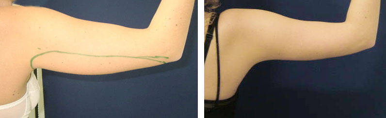Liposuktion am Arm