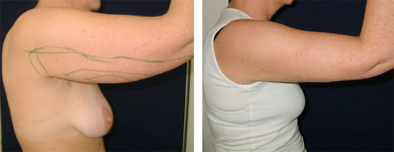 Fettabsaugung am Arm