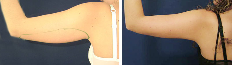 Liposuktion am Arm