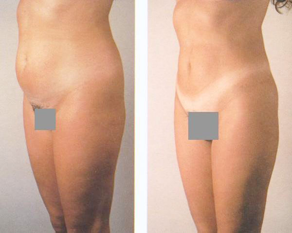 Fettabsaugung an Bauch und Hüfte