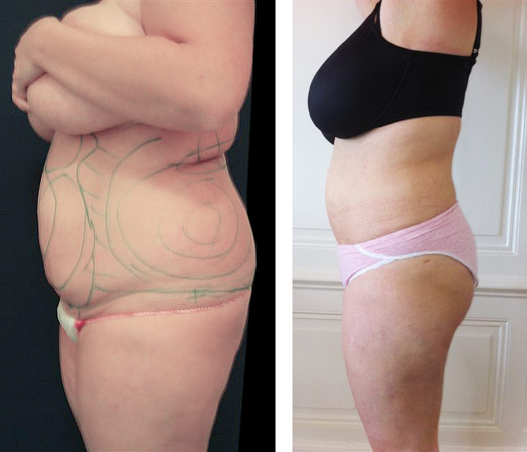 Fettabsaugung an Bauch, Taille und Rücken Fettabsaugung an Bauch, Taille und Rücken