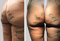Cellulite mit tiefen Dellen: Die zu behandelnden Stellen werden angezeichnet.