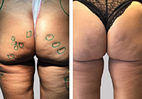 Vorher / Nachher: Zwei Wochen nach Behandlung der Cellulite. Etwa sechs Wochen nach dem Eingriff sind die Hämatome abgebaut und die behandelten Regionen abgeheilt.