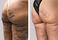 Vorher / Nachher: Zwei Wochen nach Behandlung der Cellulite.