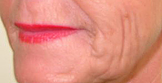 Kinn- und Wangenfalten vor und nach einer Fadenlifting-Behandlung mit Filler