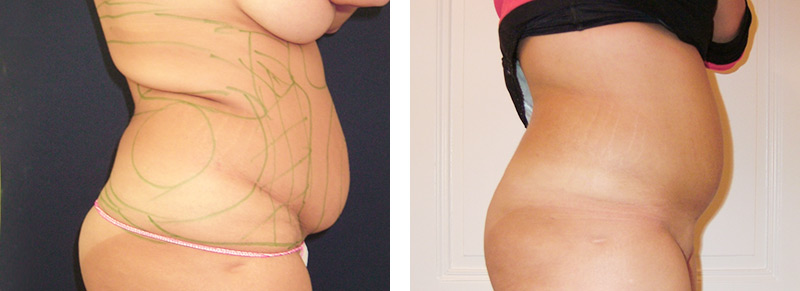 Fettabsaugung an Bauch und Taille