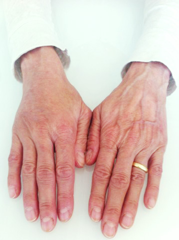 Die rechte Hand nach einer Faltenbehandlung zur Hautverjüngung im Vergleich zur linken Hand Die rechte Hand nach einer Faltenbehandlung zur Hautverjüngung im Vergleich zur linken Hand