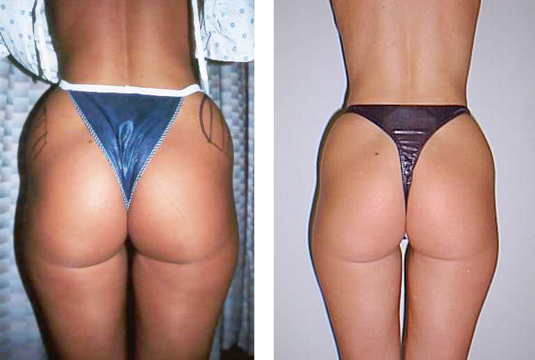 Liposuktion an Hüfte