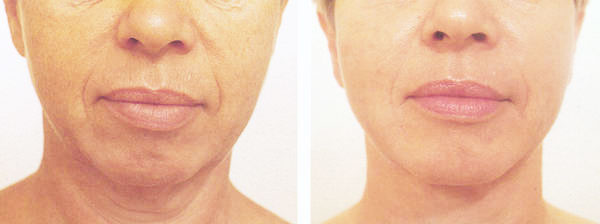 Liposuktion an Kinn / Doppelkinn