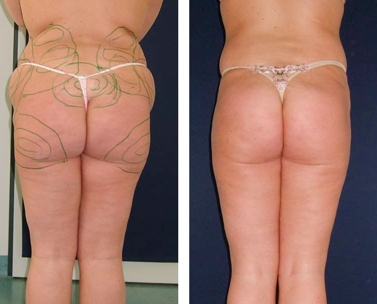 Liposuktion an Hüfte und Po