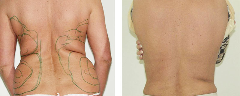 Fettabsaugung von Love Handles