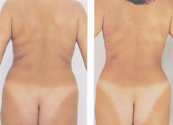 Liposuktion an Rücken, Hüfte und Po