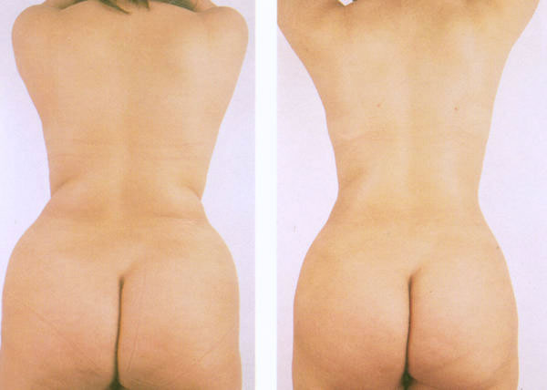 Liposuktion an Rücken und Reiterhosen