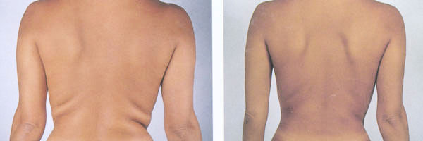 Liposuktion an Love Handles