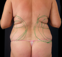 Contouring des Rückens durch Fettabsaugung