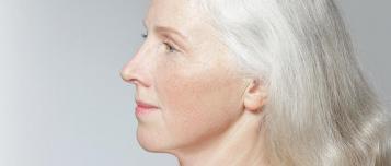 Erfahren Sie mehr über Liposculpturing am Gesicht
