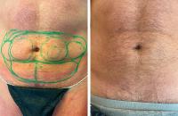 Fettabsaugung und Hautstraffung ohne Operation am Bauch