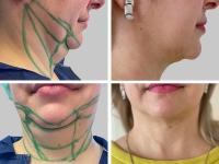 Vorher/nachher: Fettabsaugung Doppelkinn